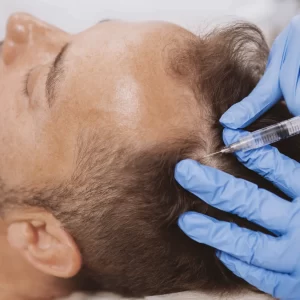 PRP For Hair Restoration